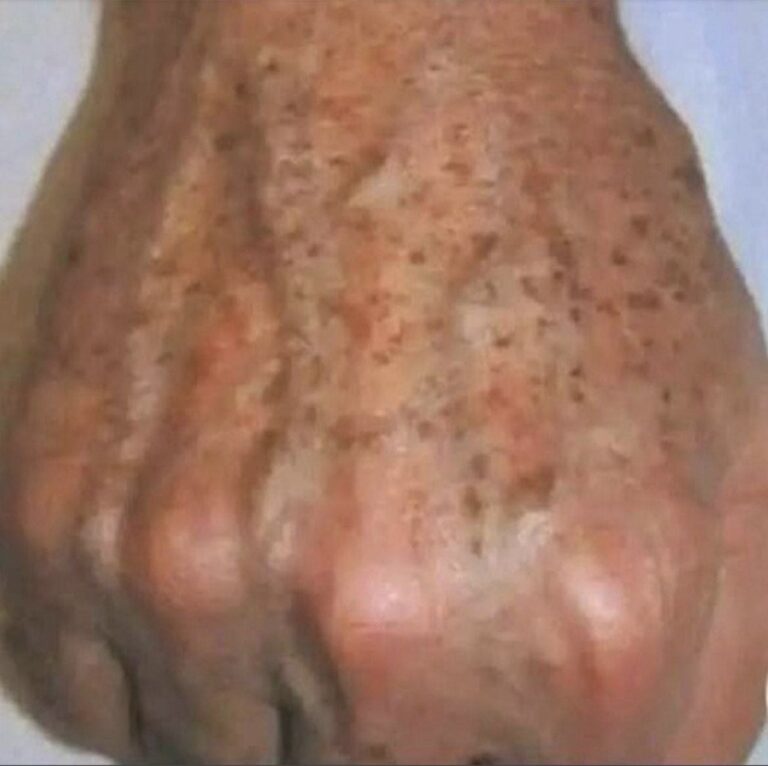 Perché compaiono le macchie sulle mani e come rimuoverle?