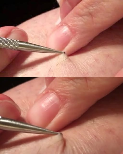 Tutto è iniziato con un prurito, e poi lo shock! Un uomo ha trovato un puntino nero sulla gamba e ha iniziato a tirarlo fuori... Ciò che ha portato via ha lasciato milioni di persone senza parole.