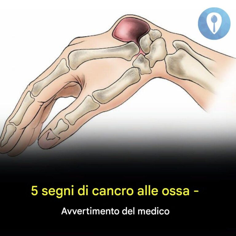 5 segnali del cancro alle ossa: l'avvertimento del medico
