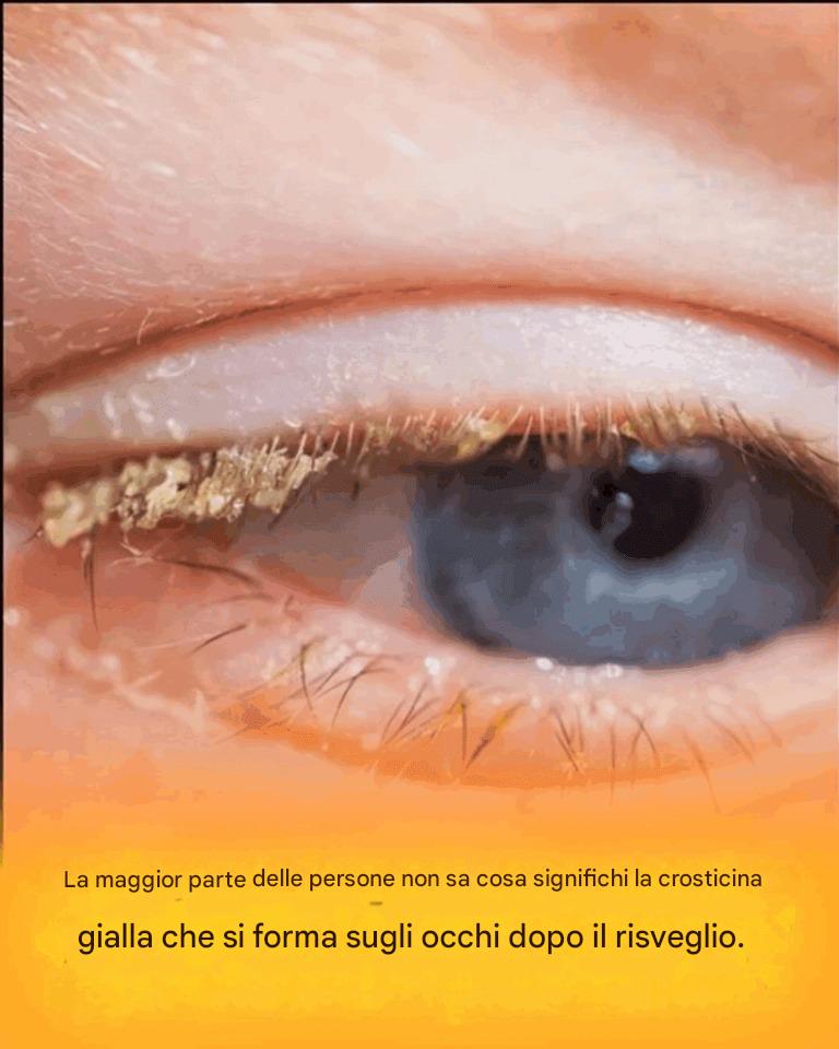 Crosta gialla al risveglio: cosa significa?